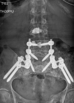 SK Spine | Air Abrasion, Juvederm&reg; and VELscope&reg; Cancer Screening