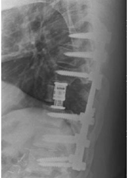 SK Spine | Ceramic Crowns, Fluoride Treatment and Extractions