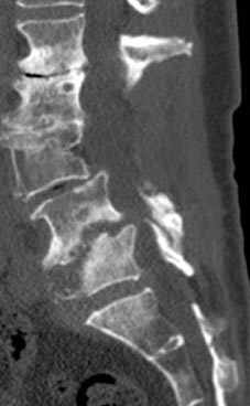 SK Spine | Oral Exams, Laminectomy/Laminotomy and Digital Impressions