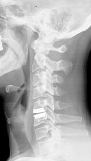 SK Spine | Full Mouth Reconstruction, Dental Bridges and Dentures