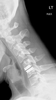 SK Spine | ClearCorrect reg , Dental Bridges and Dental Fillings