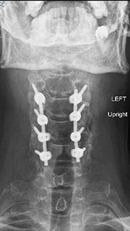 SK Spine | Laminectomy Laminotomy, Teeth Whitening and All-on-4 reg